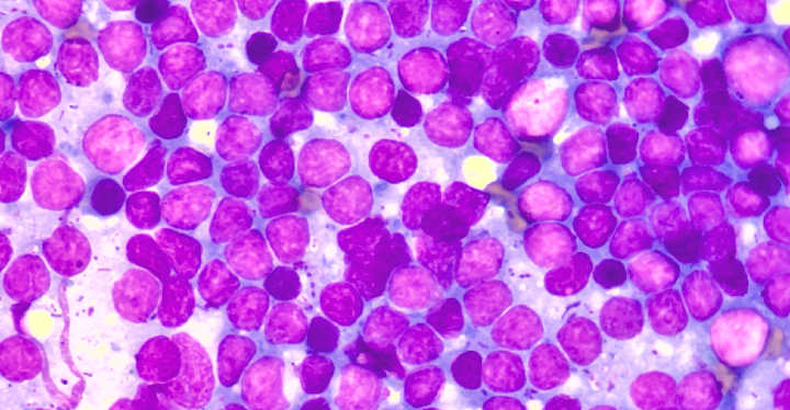 リンパ腫 細胞診