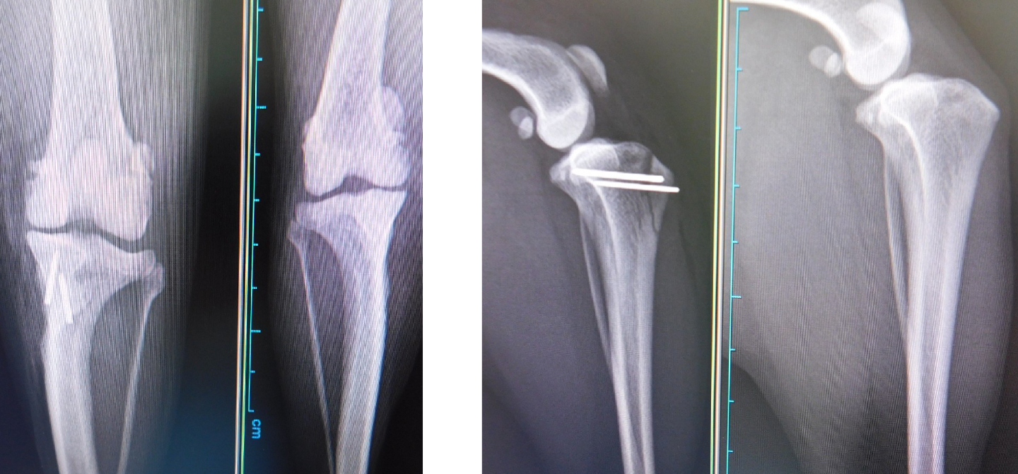 膝蓋骨内方脱臼整復