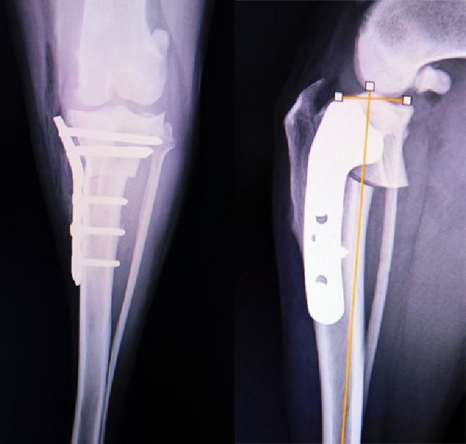 大型犬前十字靭帯断裂　TPLO
