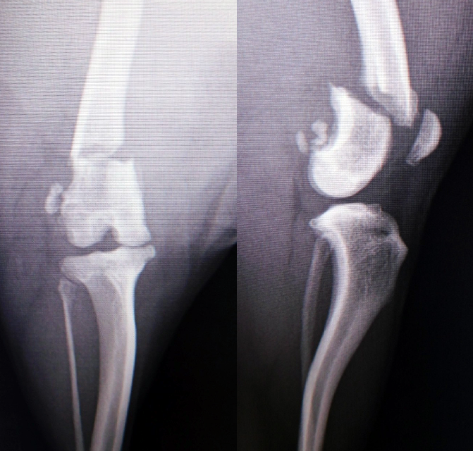 【術前】大腿骨遠位端骨折プレート整復固定