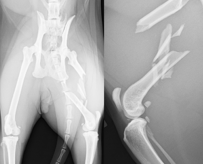 【術前】大腿骨粉砕骨折プレート整復固定