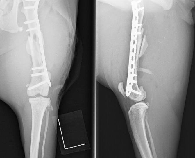 【術後】大腿骨粉砕骨折プレート整復固定