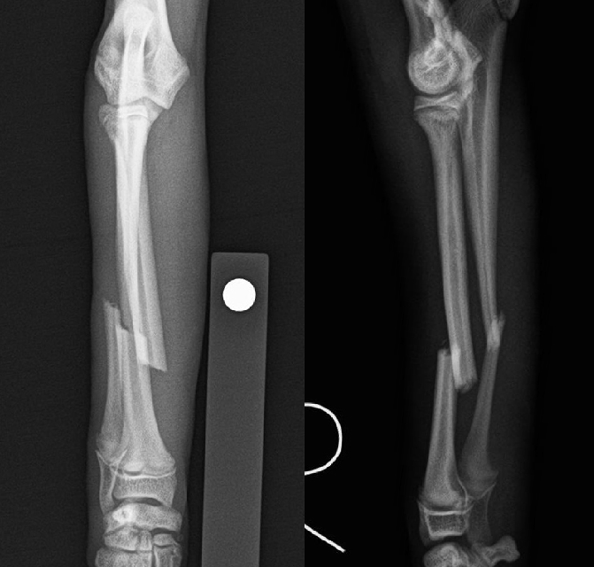 【術前】橈尺骨遠位端プレート整復固定