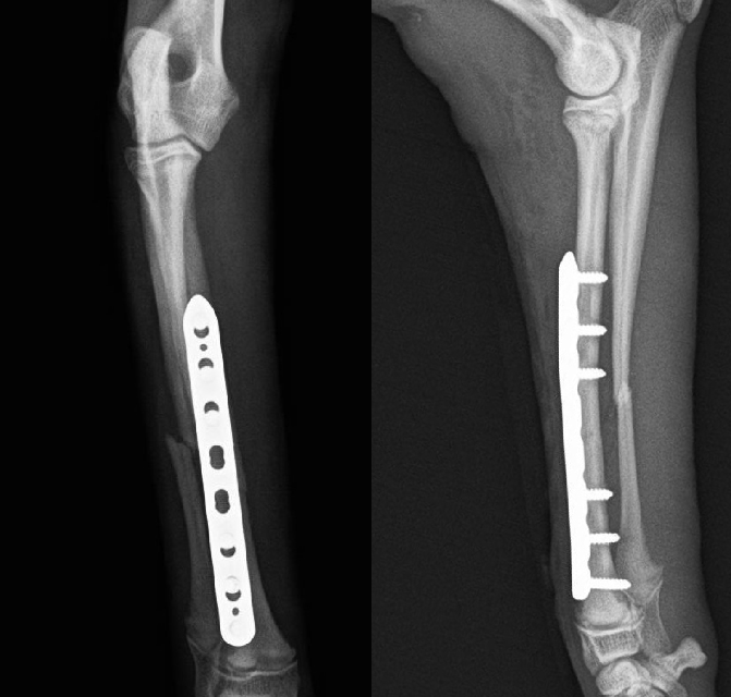 【術後】橈尺骨遠位端プレート整復固