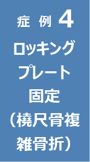 症例4　ロッキングプレート固定（橈尺骨複雑骨折）