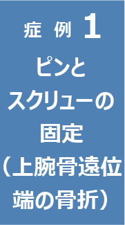 症例1　ピンとスクリューの固定（上腕骨遠位端の骨折）