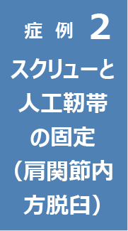 症例2　スクリューと人工靭帯の固定（肩関節内方脱臼）